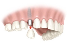 Implantes 1