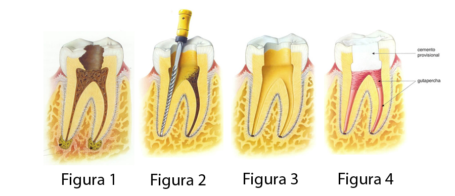 Endodoncia 1