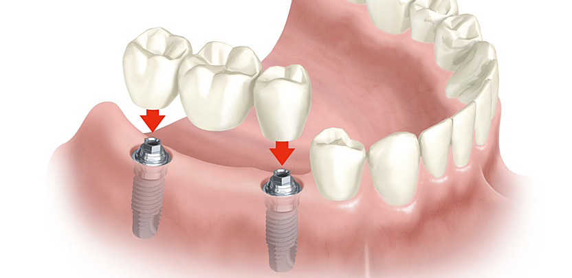 Implantes 1