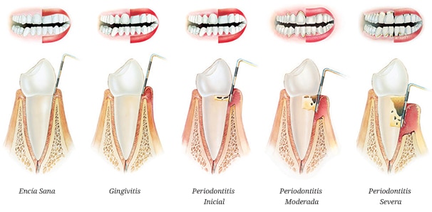 Enfermedad de las encías 1