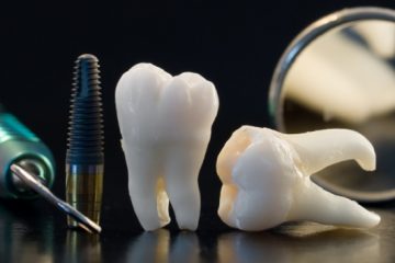 implantes dentales