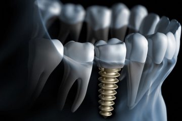 implantes dentales