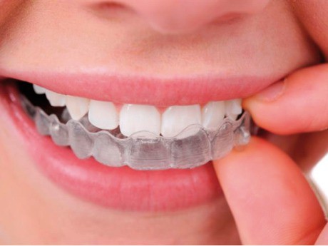 Ortodoncia Invisalign