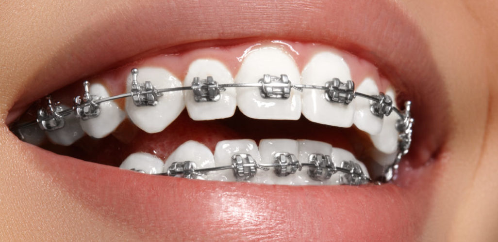 brackets metalicos colmenar viejo